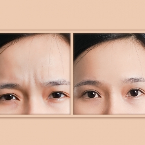 Đừng để nếp nhăn giữa 2 chân mày khiến bạn già đi chục tuổi!