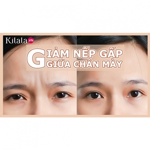 Clip: Bài tập đánh bay nếp nhăn giữa chân mày