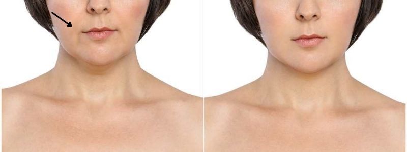 nếp nhăn má nếp nhăn má