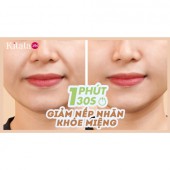 Clip: 1 phút 30 giây giảm nếp nhăn khóe miệng